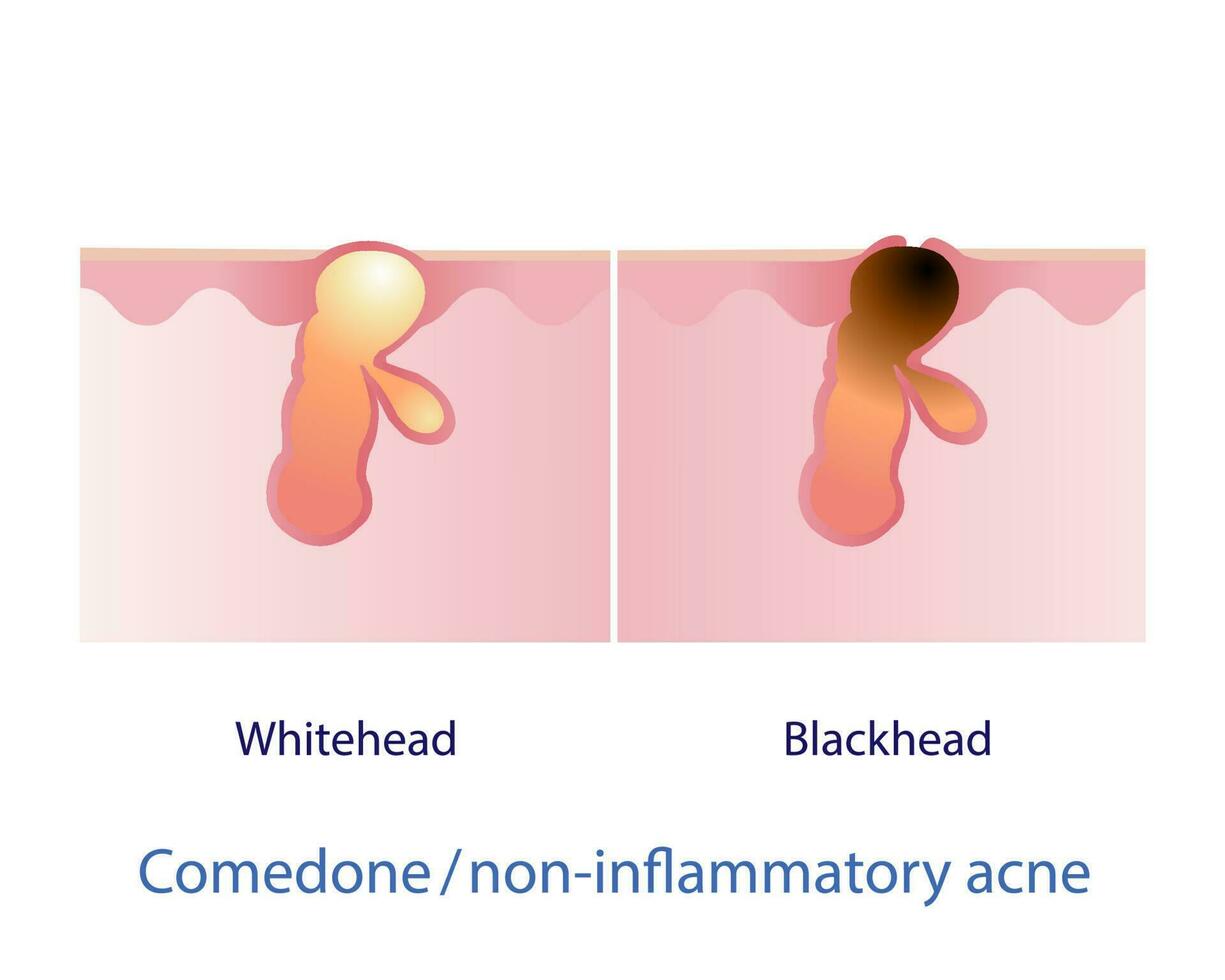 Types of comedone, non inflammatory acne vector on white background. Closed comedone, whitehead. Open comedone, blackhead. Skin care and beauty concept illustration.