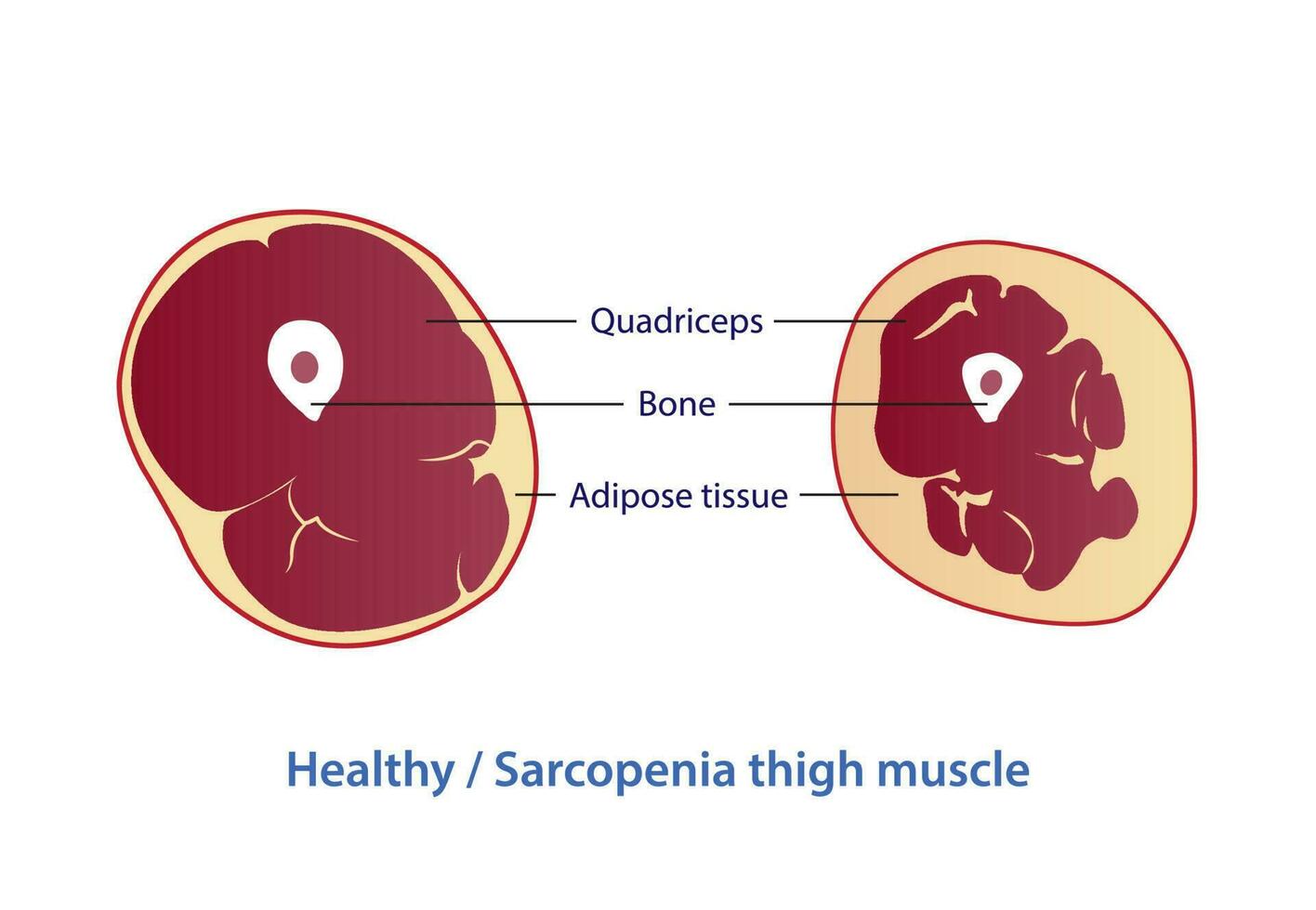 Infographic of healthy and sarcopenia thigh muscle vector illustration isolated on white background. Cross section of strength and losing muscle mass. Anatomy and health care concept illustration.
