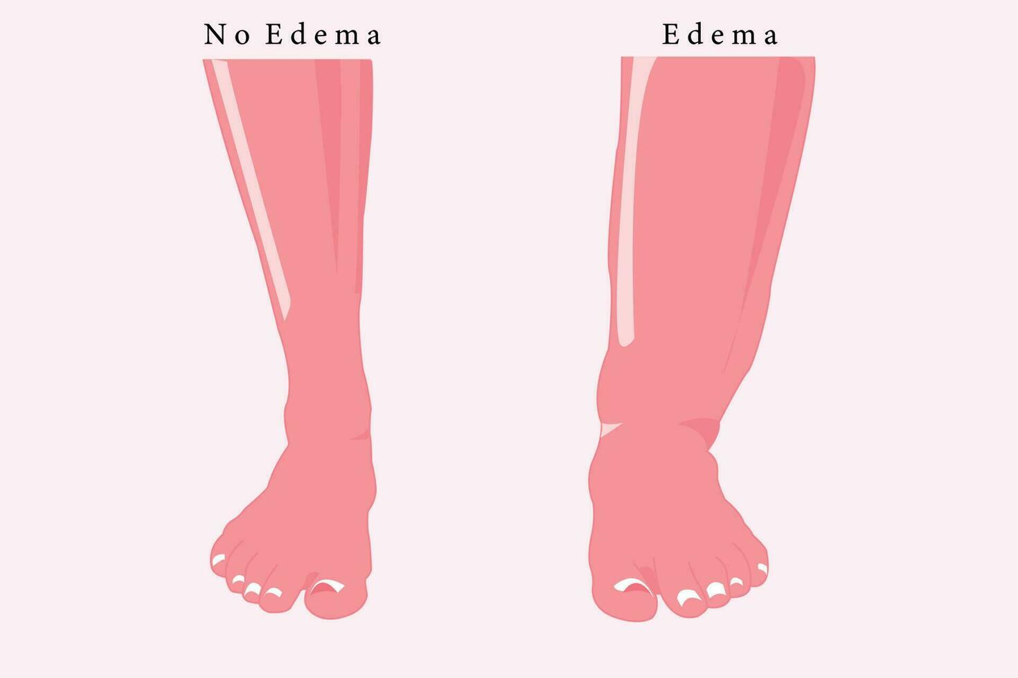 comparation of normal foot and edema foot, flat illustration for education. eps 10 vector