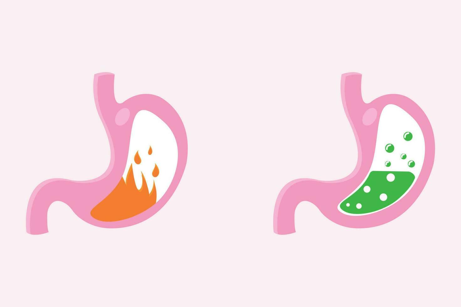 illustration of pyrosis stomach and nausea stomach. Pyrosis fire disorder, gastric acid reflux. Stomach medical illustration set vector