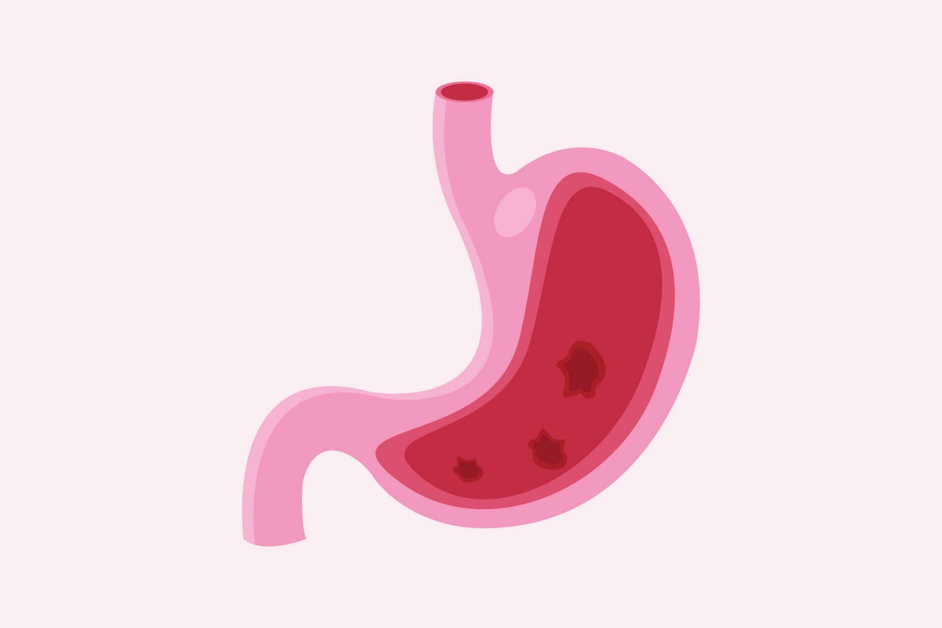 indigestion. Stomach ulcer. Anatomical vector illustration of the