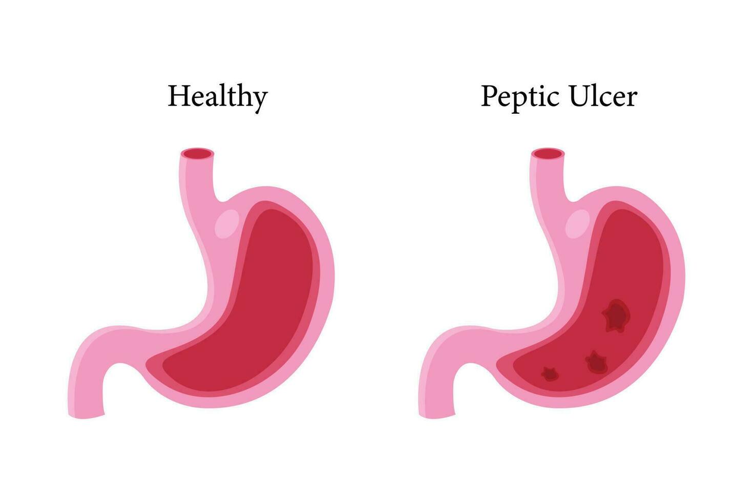 Stomach icon set, cartoon vector illustration. cross section of  normal and abnormal stomach