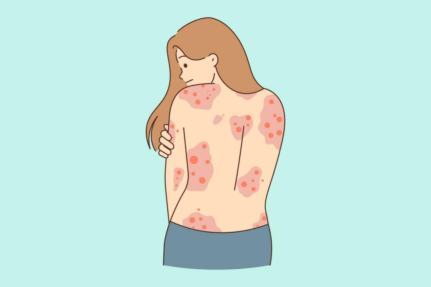 Unhealthy woman showing red rash on back suffer from dermatitis. Unwell girl struggle with dermatology disease. Healthcare concept. Vector illustration.