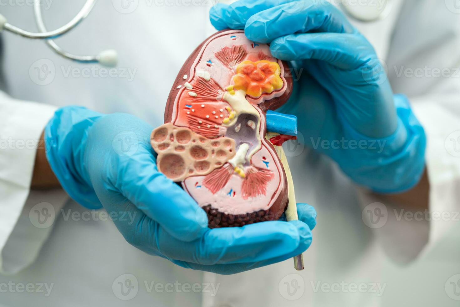 Kidney disease, Chronic kidney disease ckd, Doctor hold model to study and treat in hospital. photo