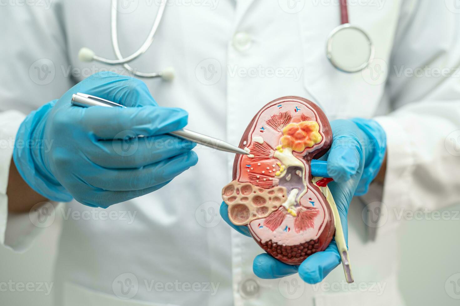 Kidney disease, Chronic kidney disease ckd, Doctor hold model to study and treat in hospital. photo