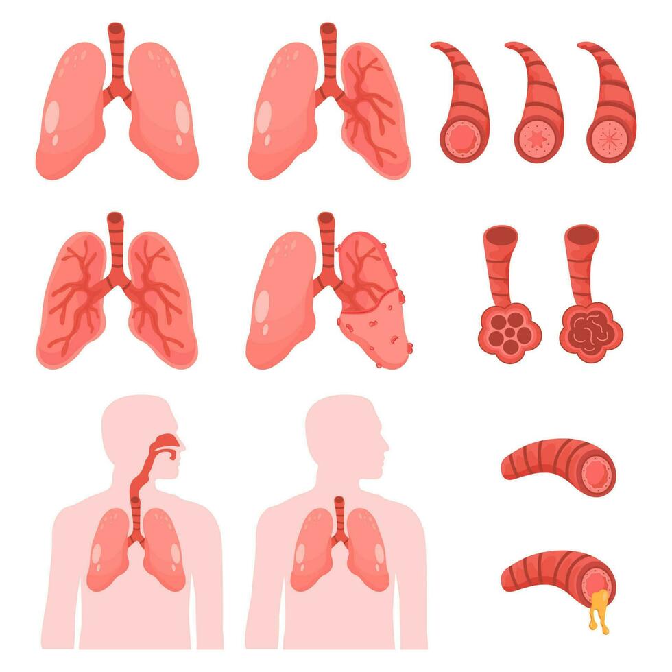 human Lungs vector clip art icon. COPD vector illustration, chronic obstructive pulmonary explanation