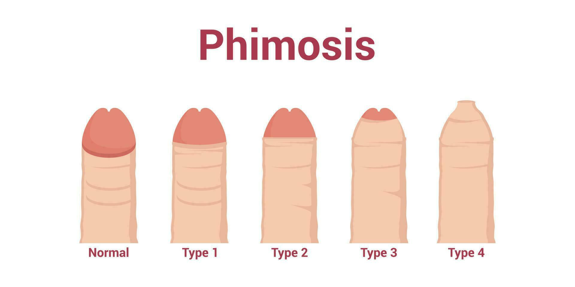 Types of phimosis. Inability to retract the foreskin covering the