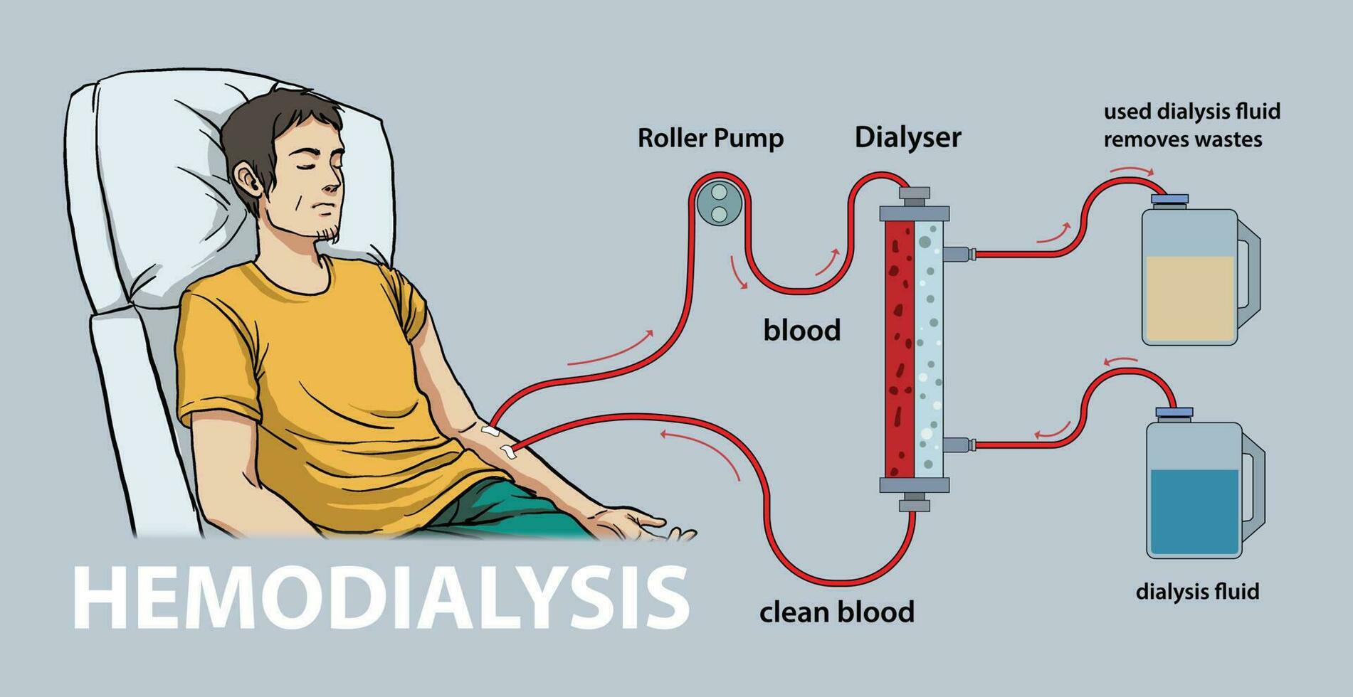 illustration of hemodialysis diagram vector