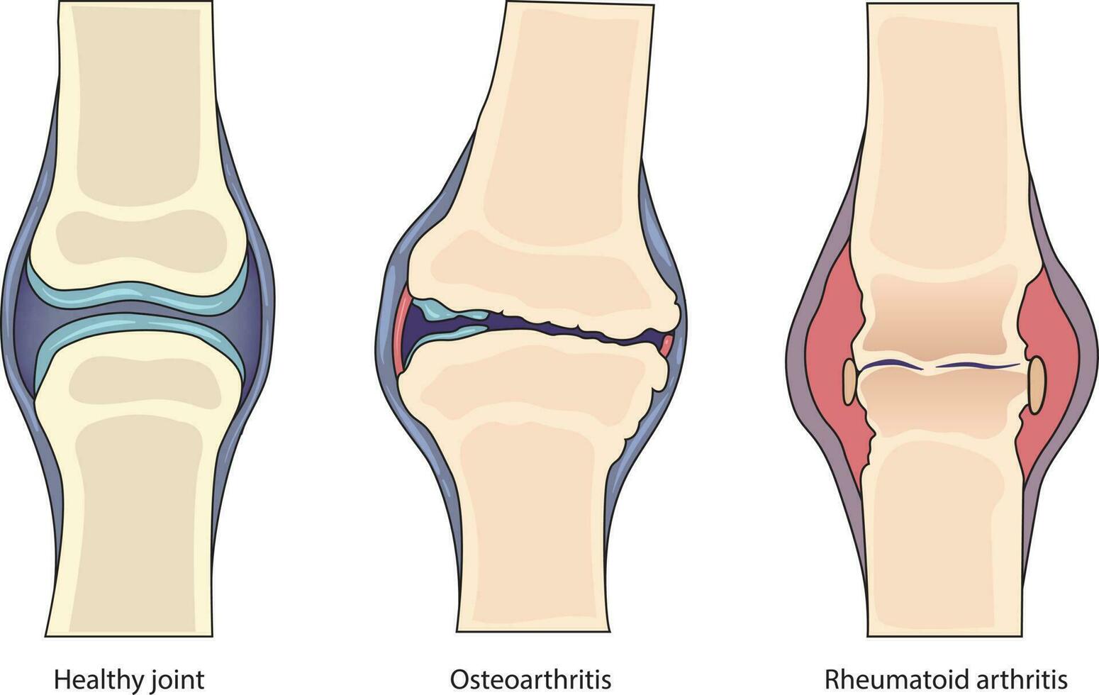 ilustración de sano articulación vs artritis comparación vector