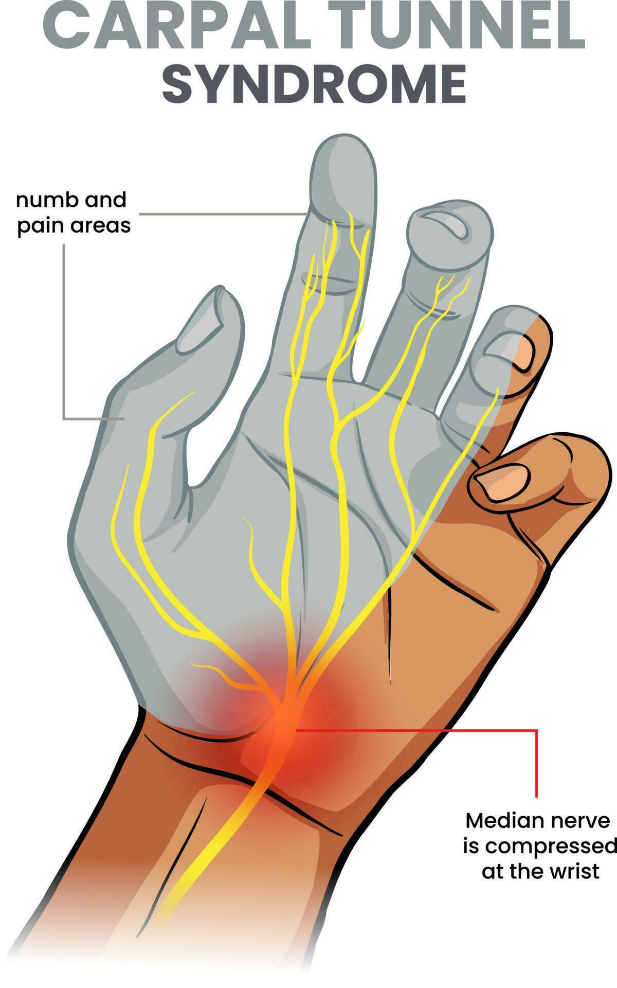 illustration of carpal tunnel syndrome 24318127 Vector Art at Vecteezy