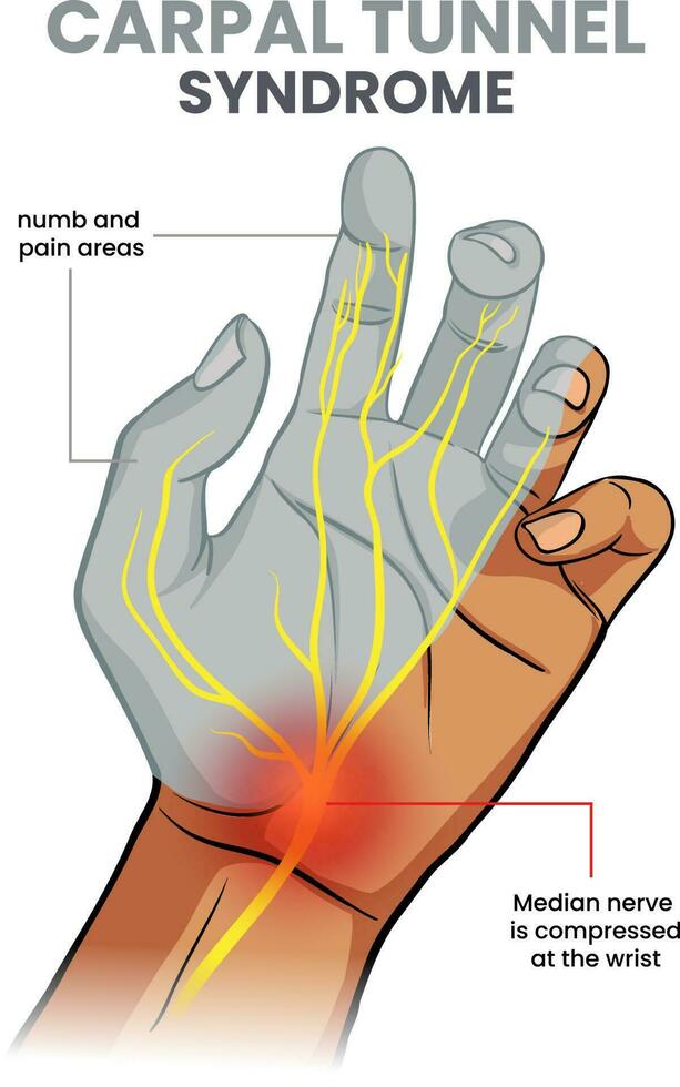 illustration of carpal tunnel syndrome vector