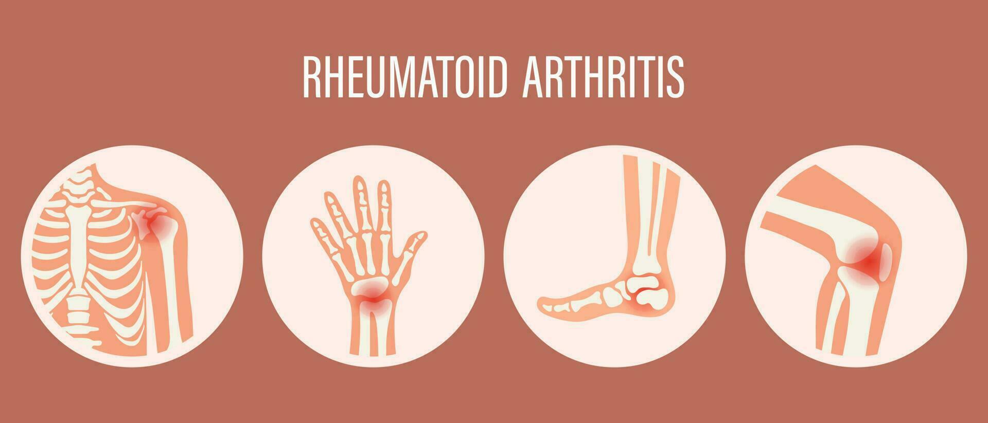 Rheumatoid arthritis icons. Knee joint, shoulder joint, wrist joint, foot joint. Types of arthritis. Medical concept. Vector