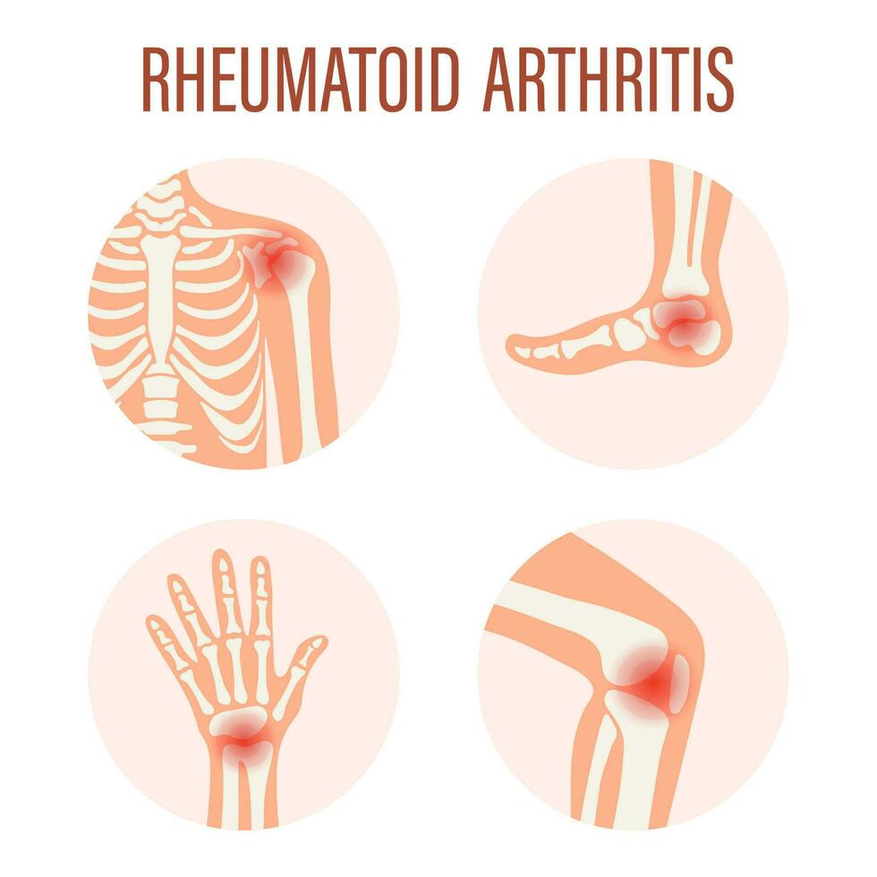 Rheumatoid arthritis icons. Knee joint, shoulder joint, wrist joint, foot joint. Types of arthritis. Medical concept. Vector