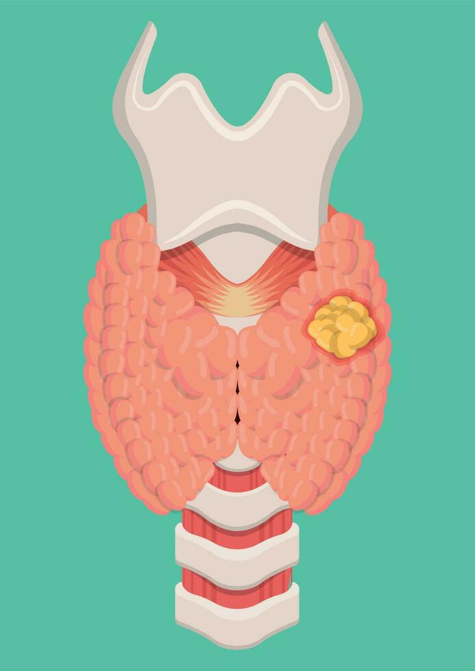 vector ilustración de tiroides cáncer aislado en azul antecedentes