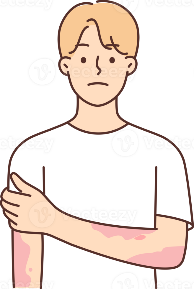 Man suffering from dermatitis and skin diseases with spots on hands needs help of dermatologist png