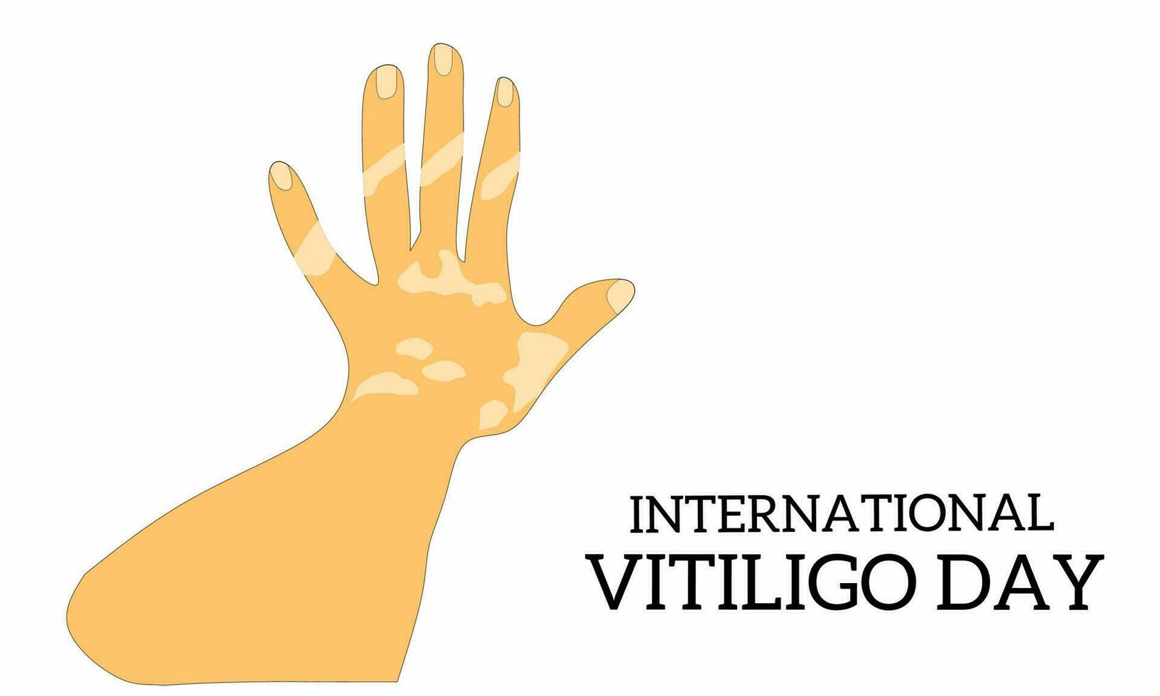 Vector graphic of international vitiligo day for international vitiligo day celebration. flat design. flyer design. June 30.