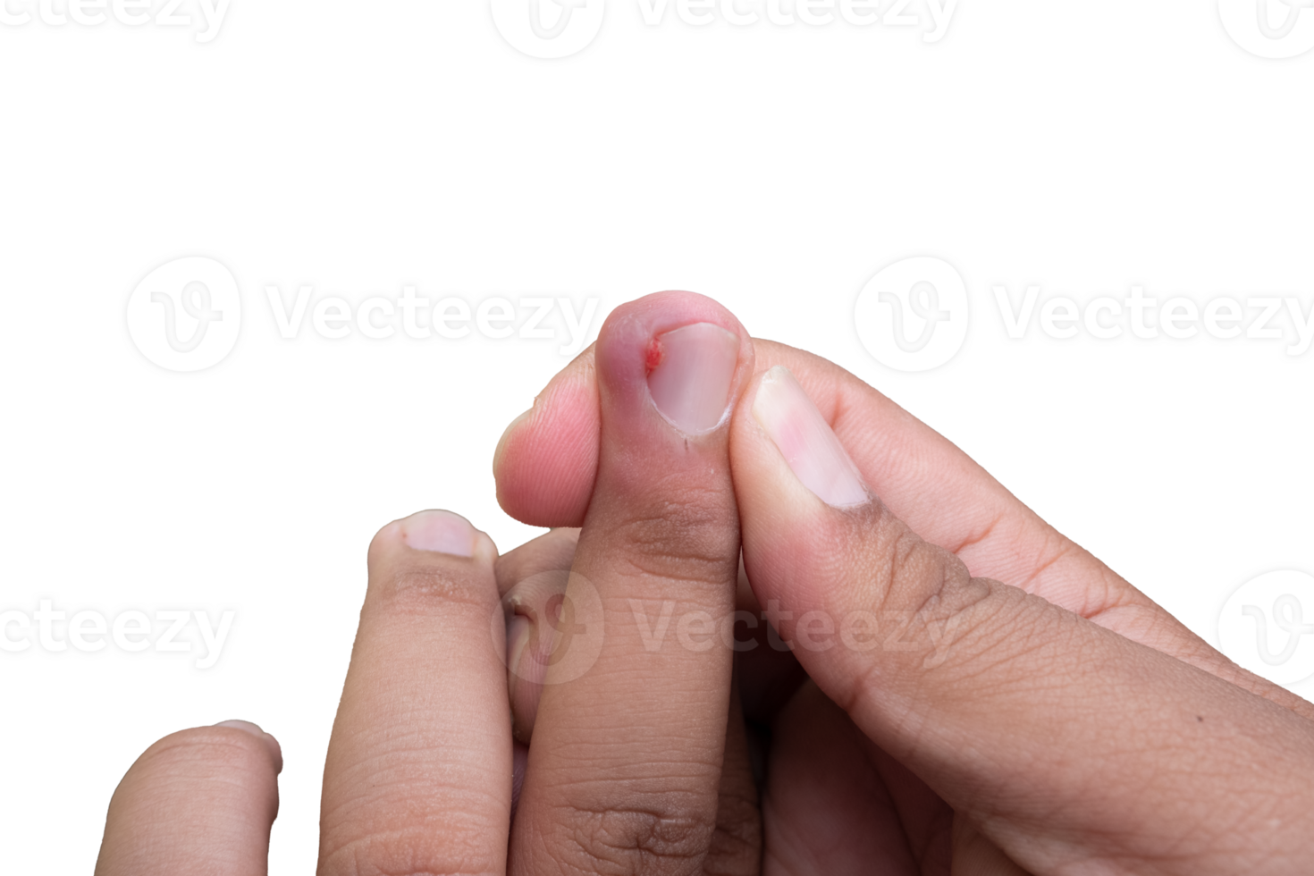 selective focus on bruised middle fingernails due to ingrown nails. in Indonesian it is called cantengan. paronychia disease. png