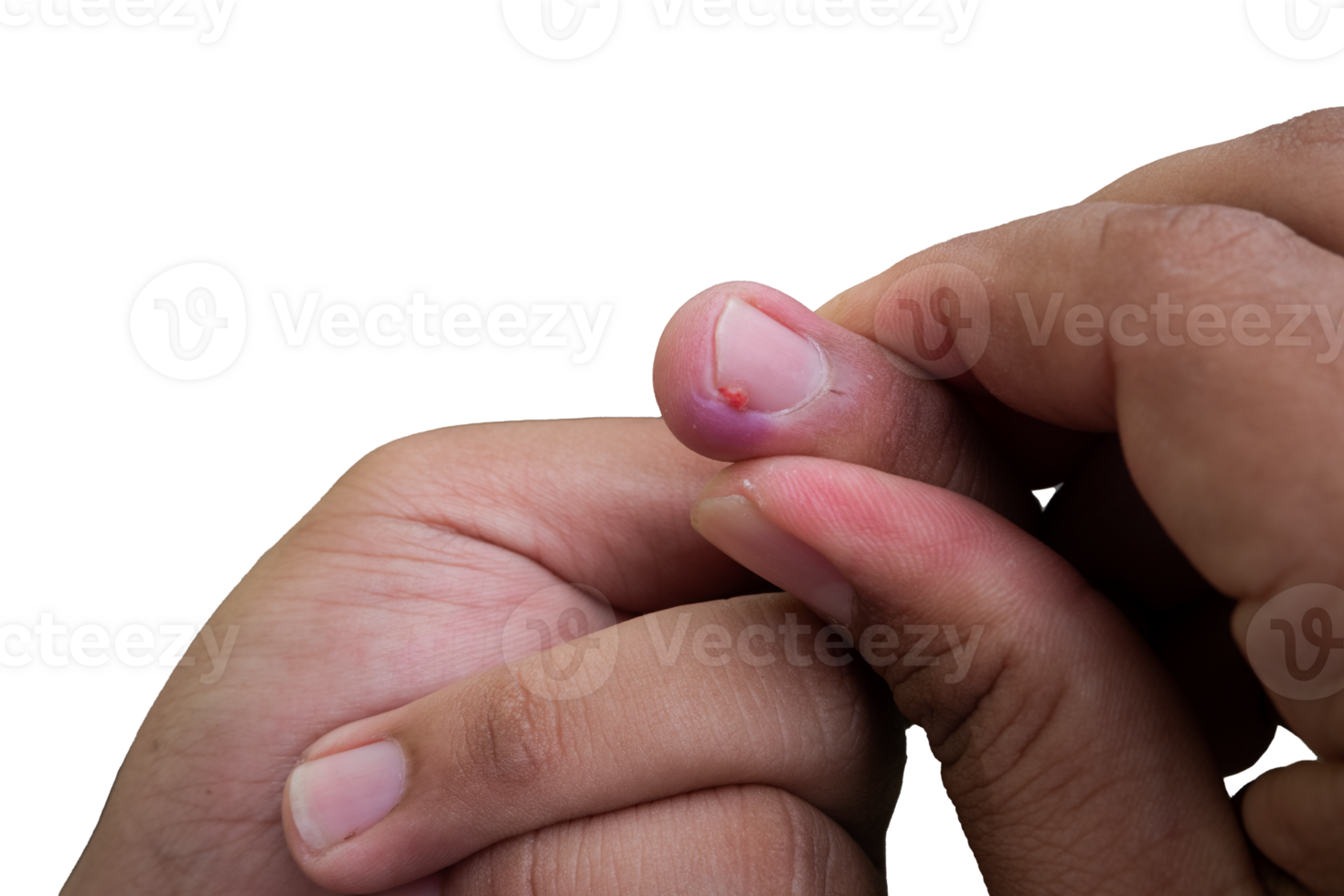 selektiv fokus på blåslagen mitten fingernaglar på grund av till ingrown spikar. i indonesiska den är kallad cantengan. paronychia sjukdom. png