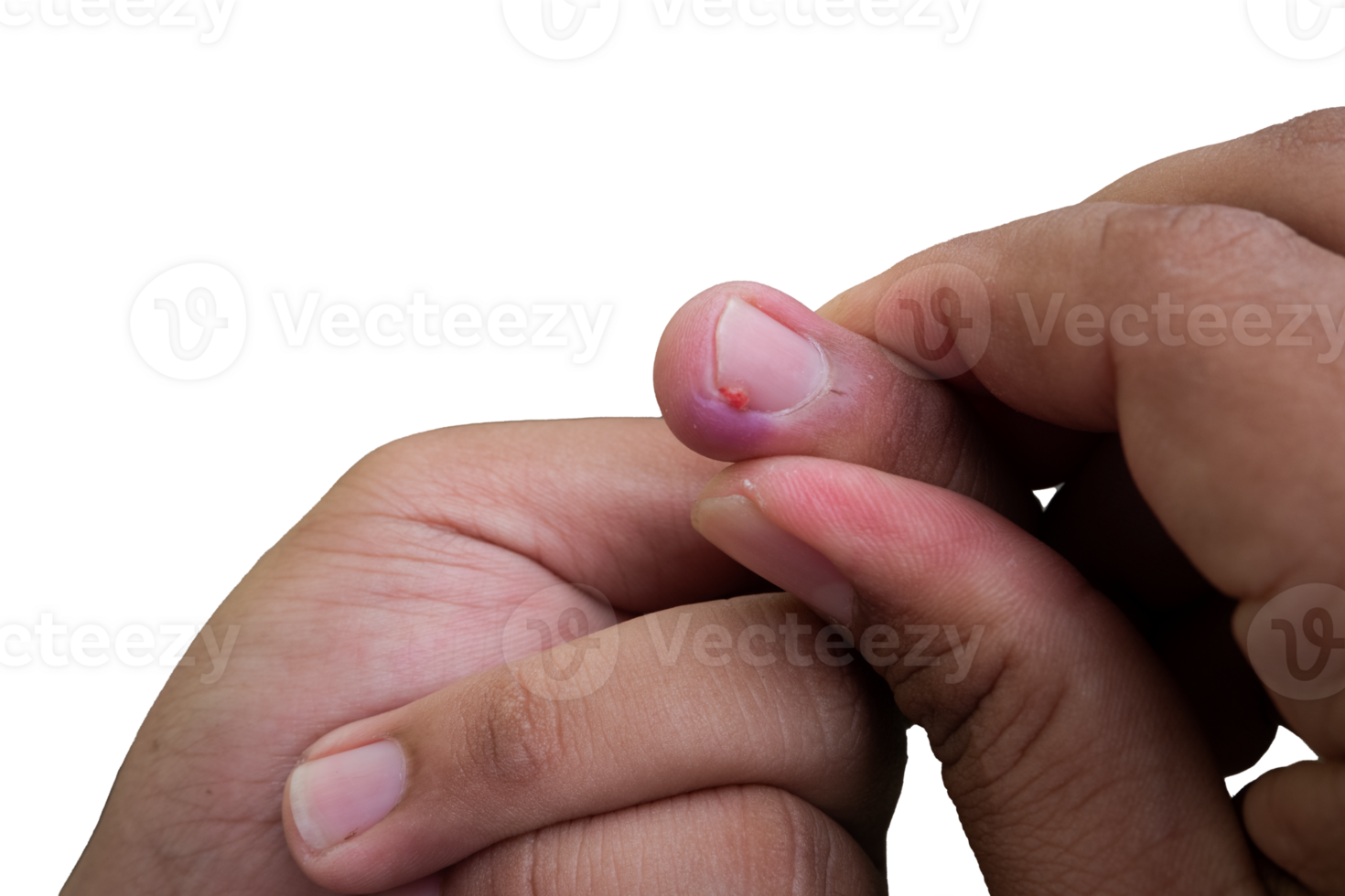 selective focus on bruised middle fingernails due to ingrown nails. in Indonesian it is called cantengan. paronychia disease. png