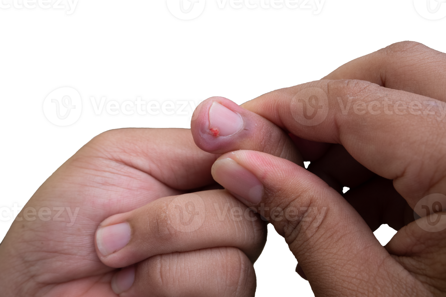 selective focus on bruised middle fingernails due to ingrown nails. in Indonesian it is called cantengan. paronychia disease. png