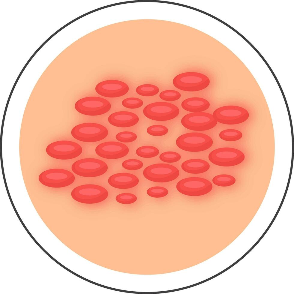 Flat Style Urticaria Disease Skin Circle Icon. vector