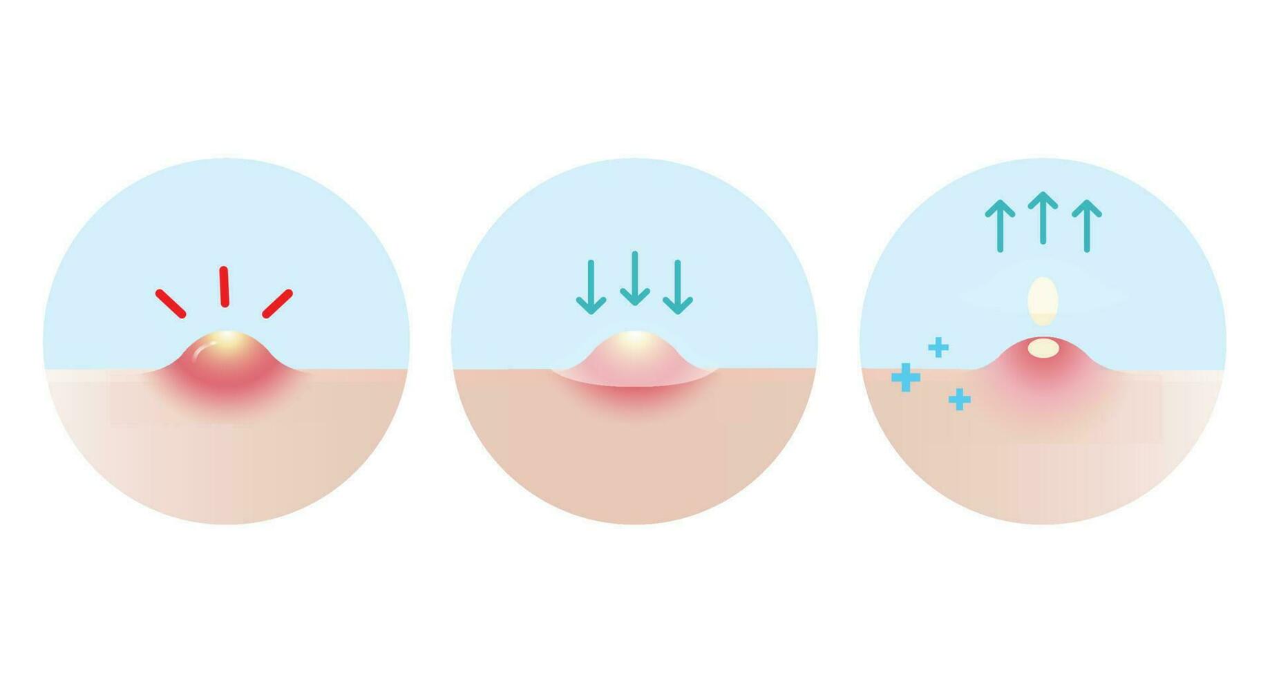 Direction for use acne pimple patch for inflammatory acne vector icon set illustration on white background. How to use, step for use acne patch absorbing pustule on skin face. Skin care concept.