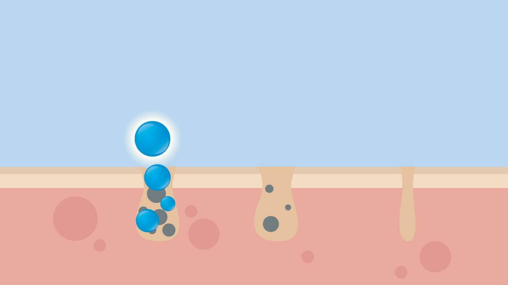 Acne Pimple treatment inflammation associated with pimples. On a blue background. The structure of the skin acne scar. Medical beauty skin care concept vector