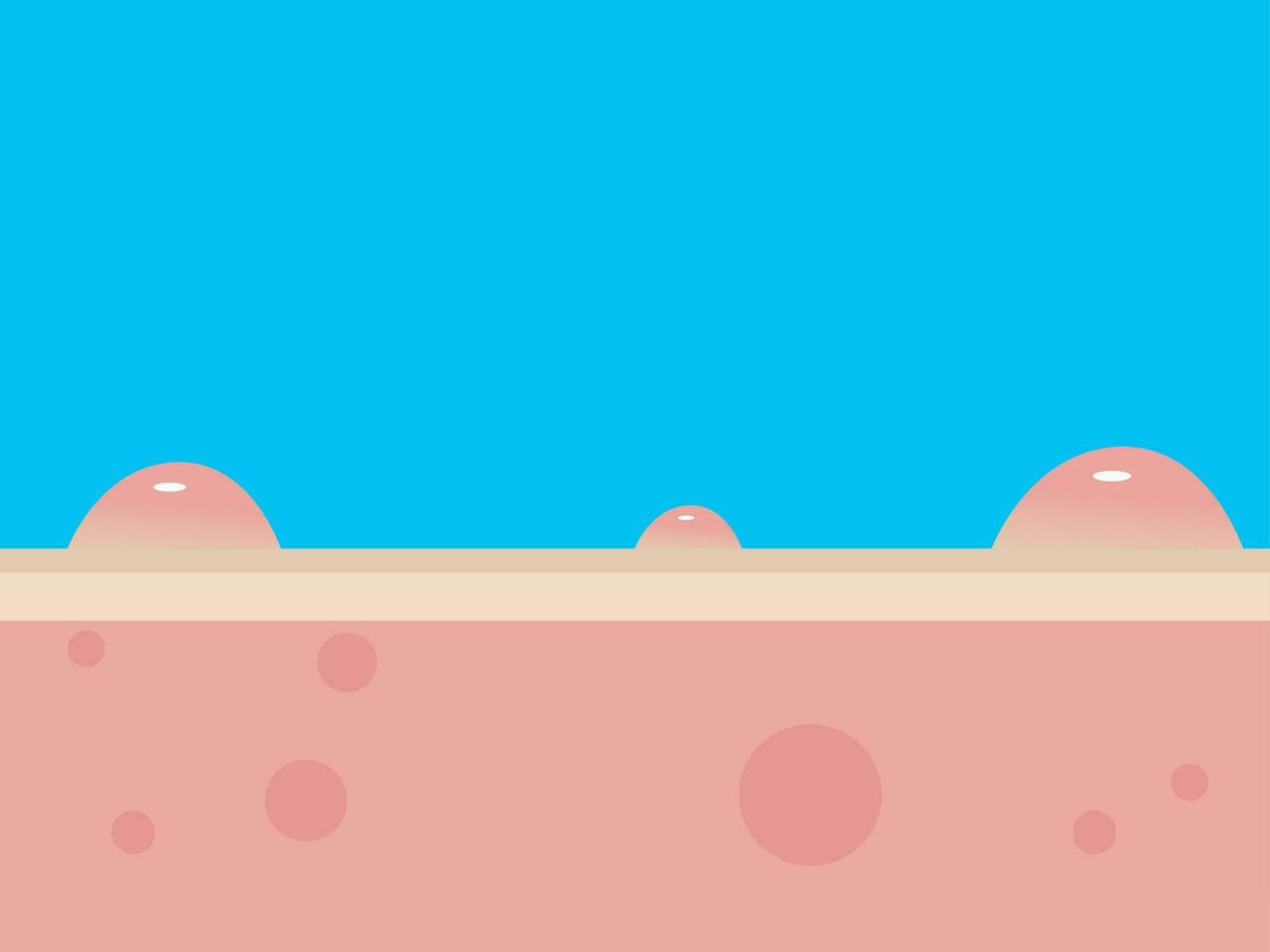 Acne Pimple treatment inflammation associated with pimples. On a blue background. The structure of the skin acne scar. Medical beauty skin care concept vector
