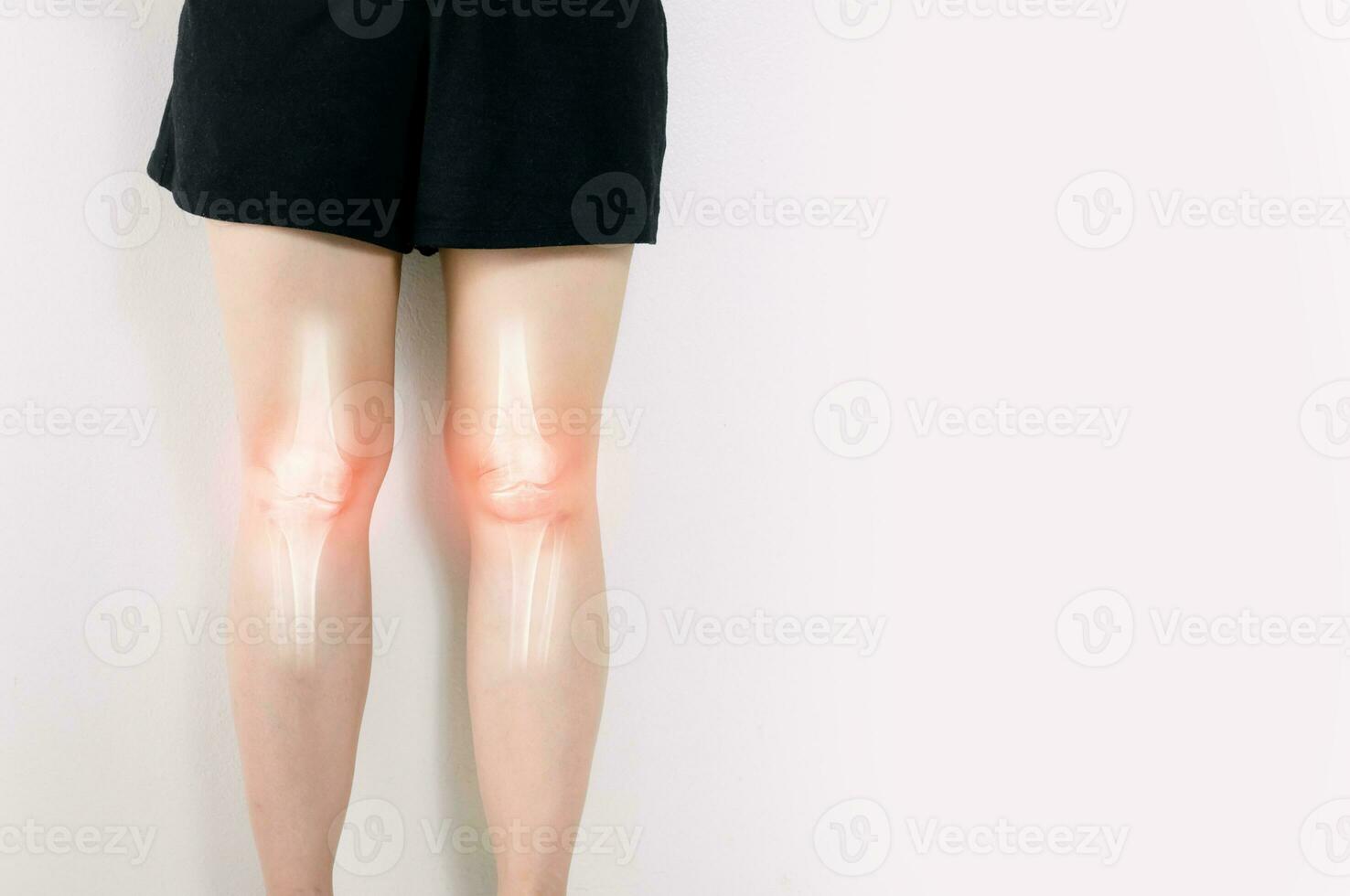 Human leg Osteoarthritis inflammation of bone joints photo