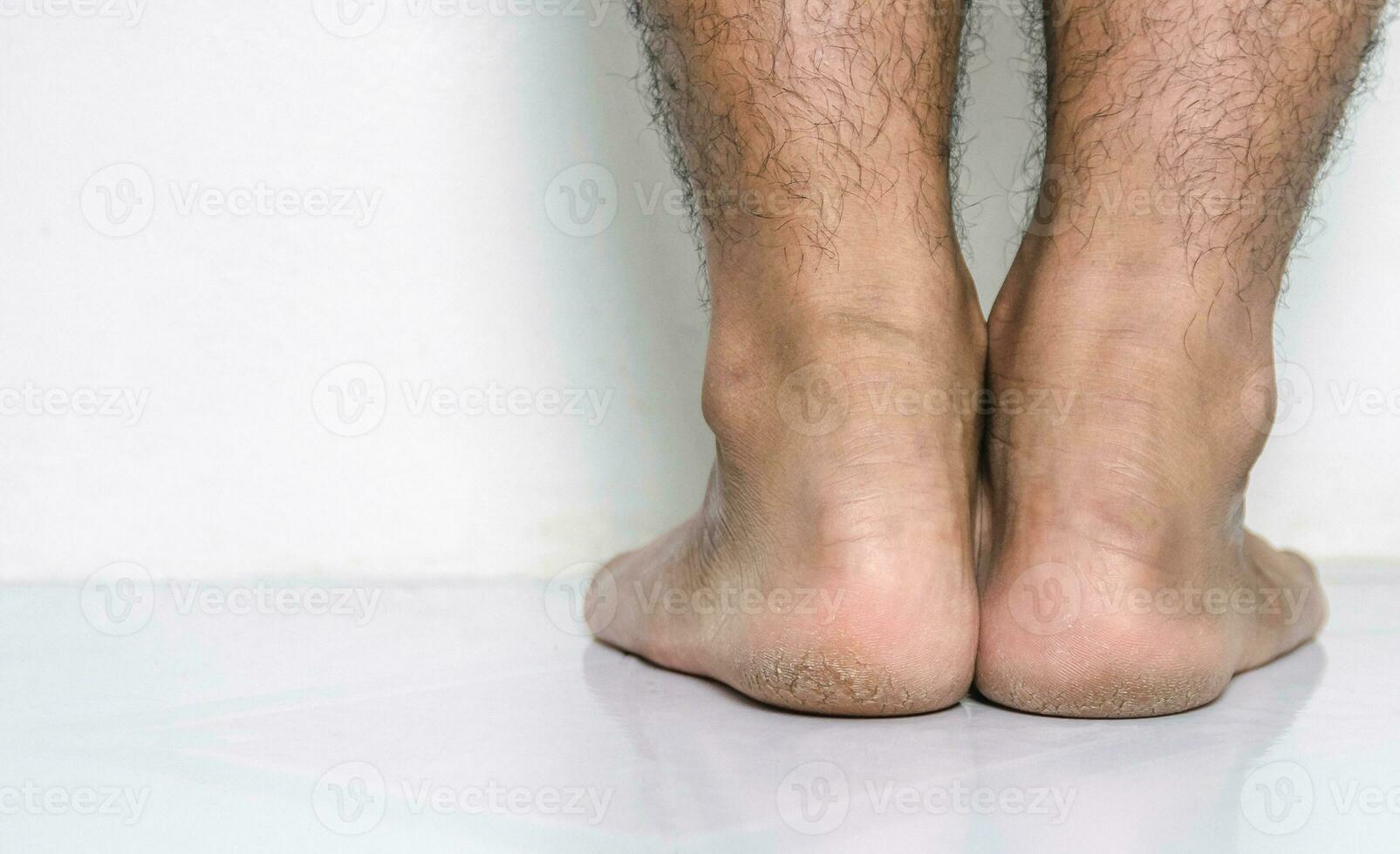 Men a feet skin cracked heels photo
