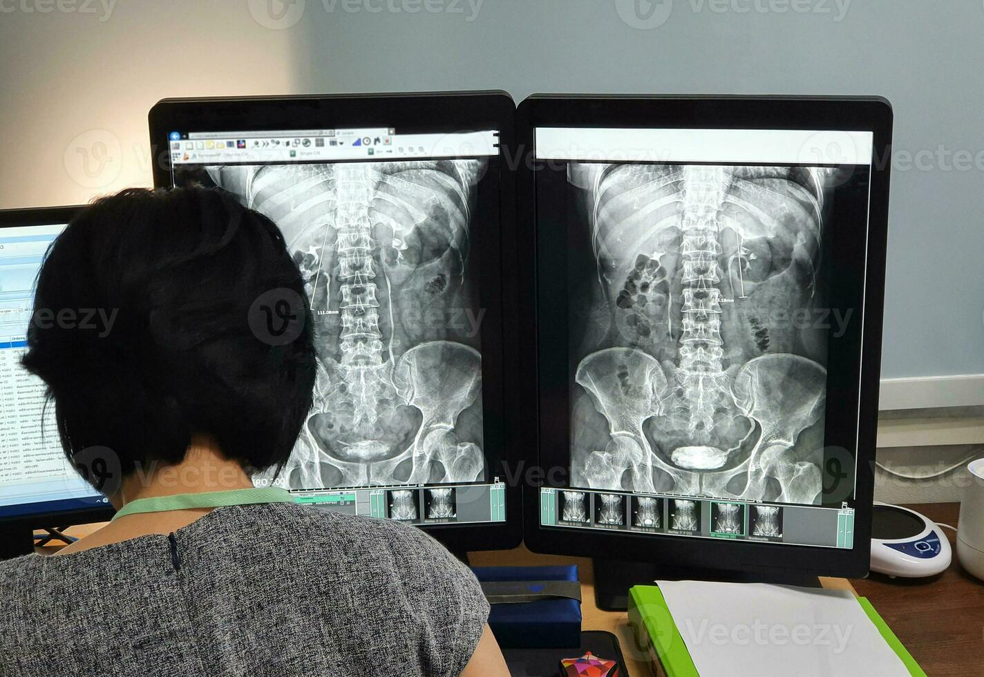 X rayo médico examina el del paciente X rayo película foto