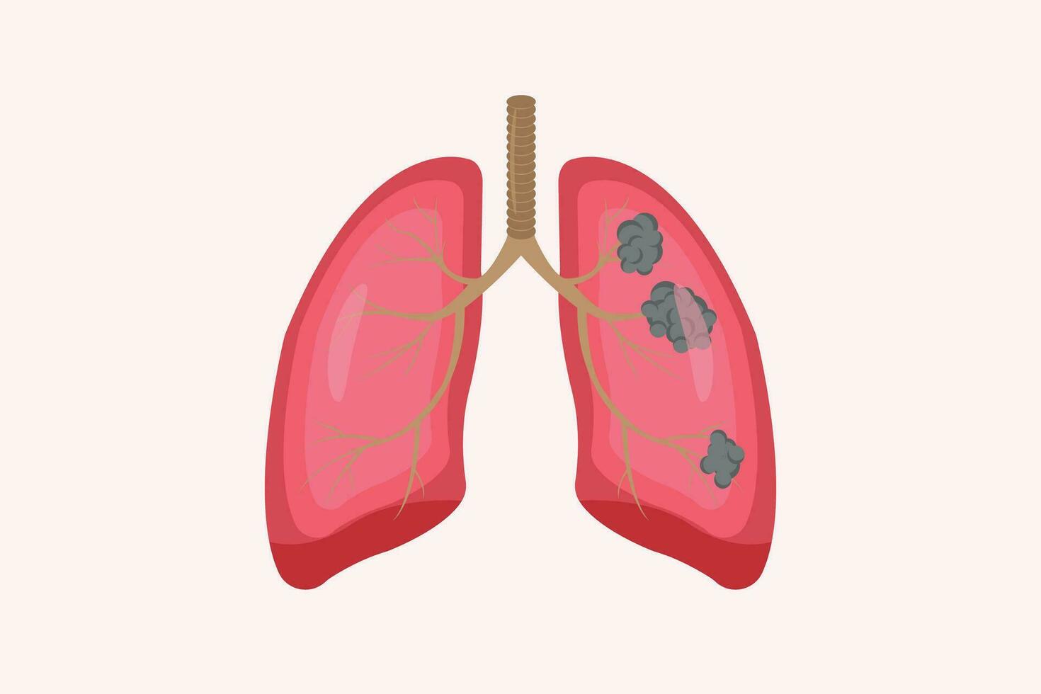 lung cancer and normal lung illustration comparation. eps 10. icon set vector