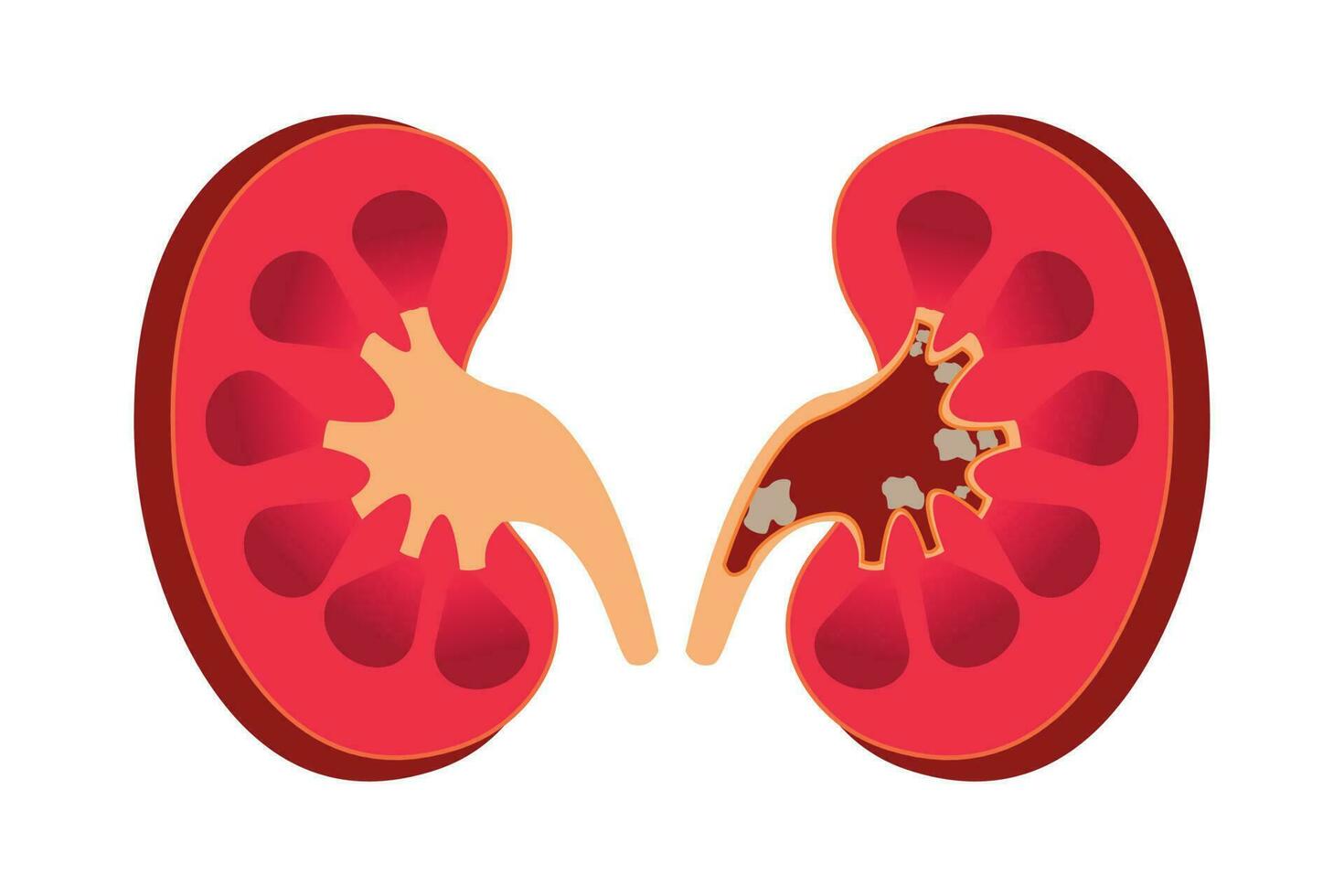 Nephrolithiasis kidney stones disease. cross section of Vector medical illustration. eps 10