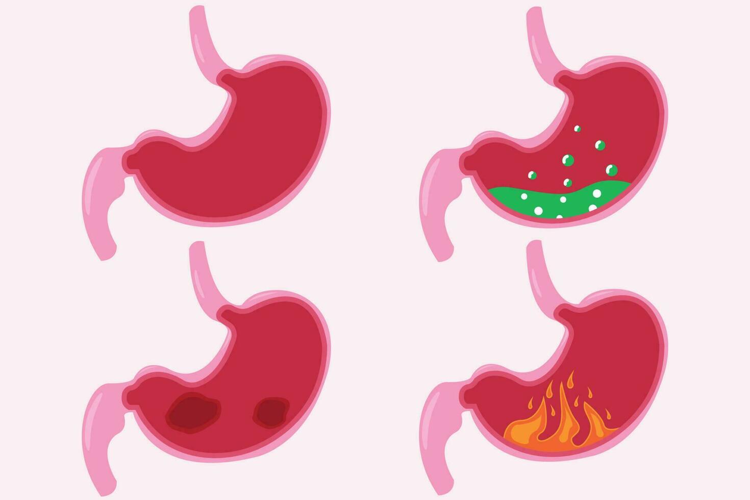 Stomach icon set, cartoon vector illustration. cross section of normal and abnormal stomach