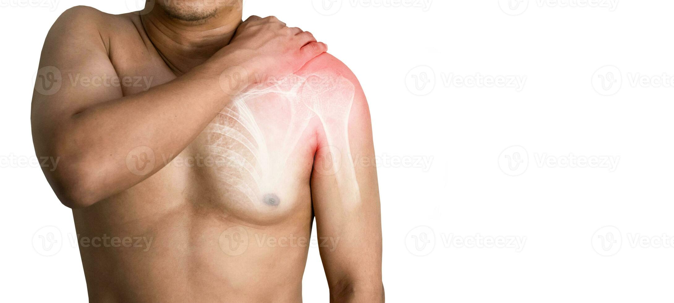 Inflammation of the muscles and bones of the arm 24605975 stock photo