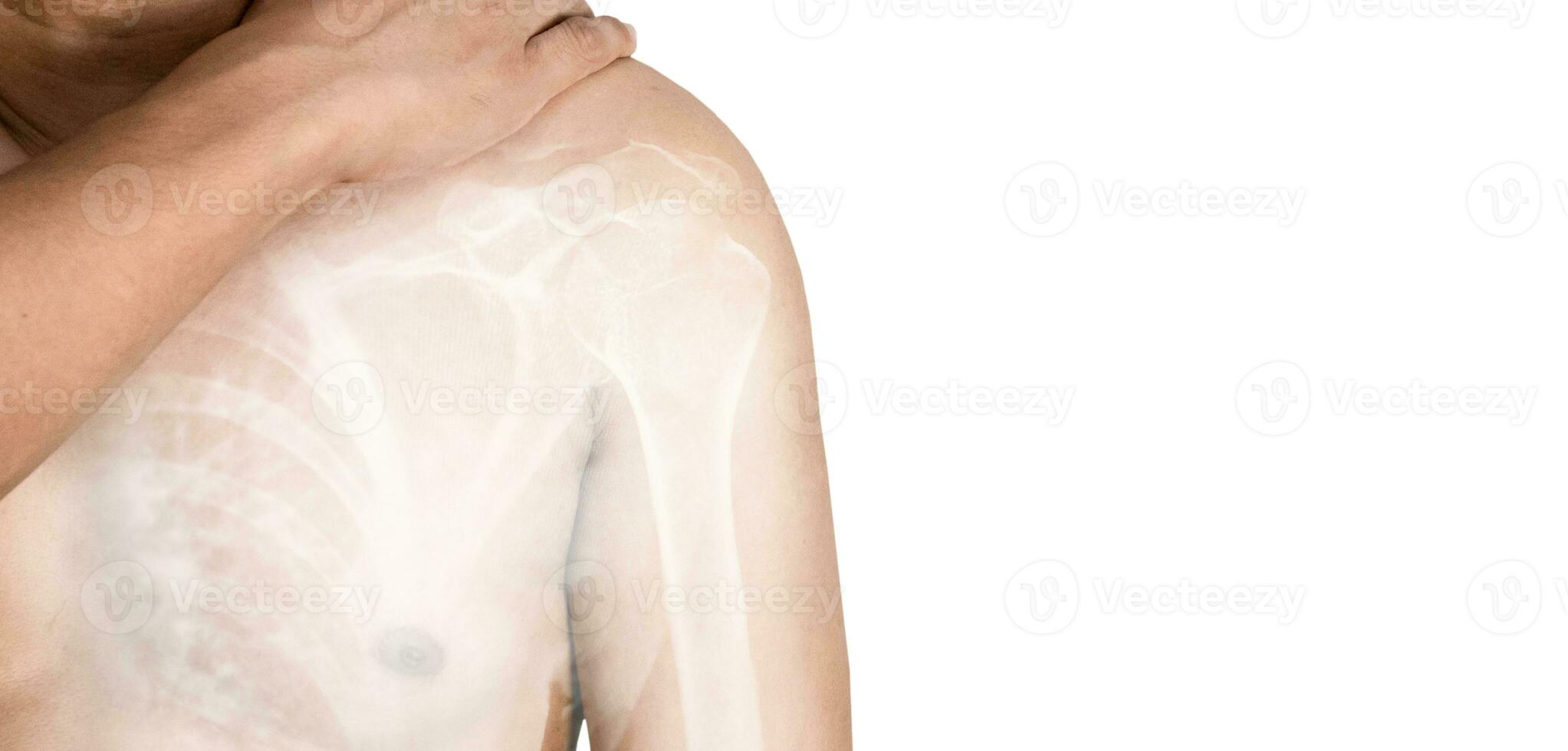 Inflammation of the muscles and bones of the arm photo