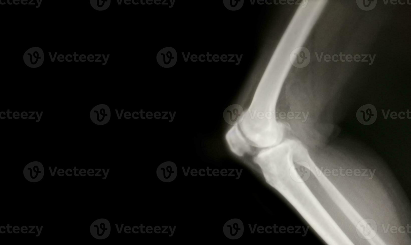 knee bone computer x-ray images photo