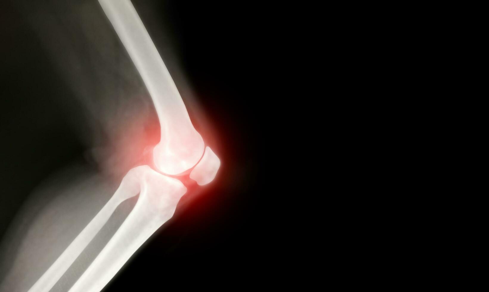 knee bone inflammation computer x-ray images photo