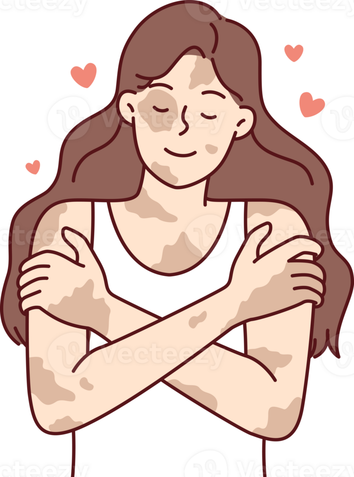 Positive girl with vitiligo disease hugging herself taking skin diseases as personal feature png