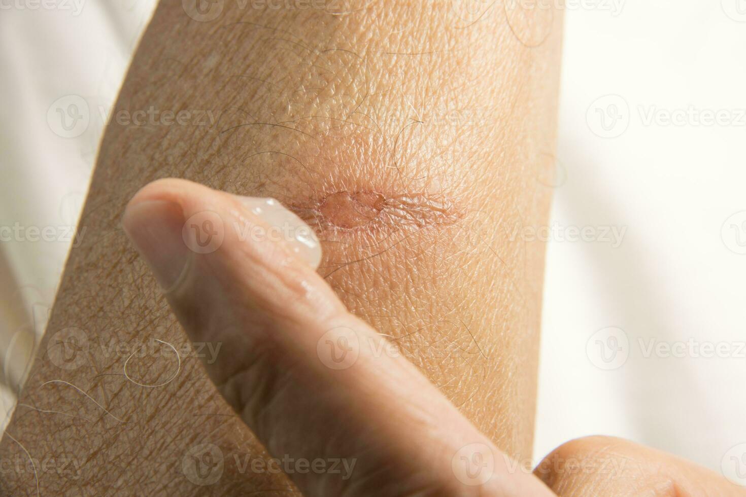 Man applying ointment to a small minor first degree burn on his forearm photo