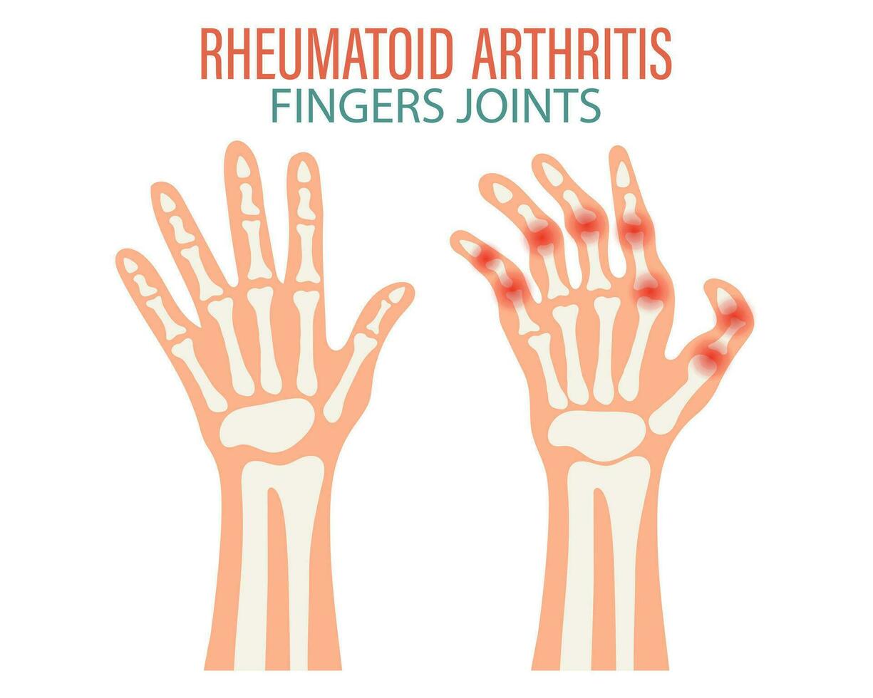 Rheumatoid arthritis. Osteoarthritis of the joints of the fingers and toes. Medical concept. Infographic poster, banner, vector