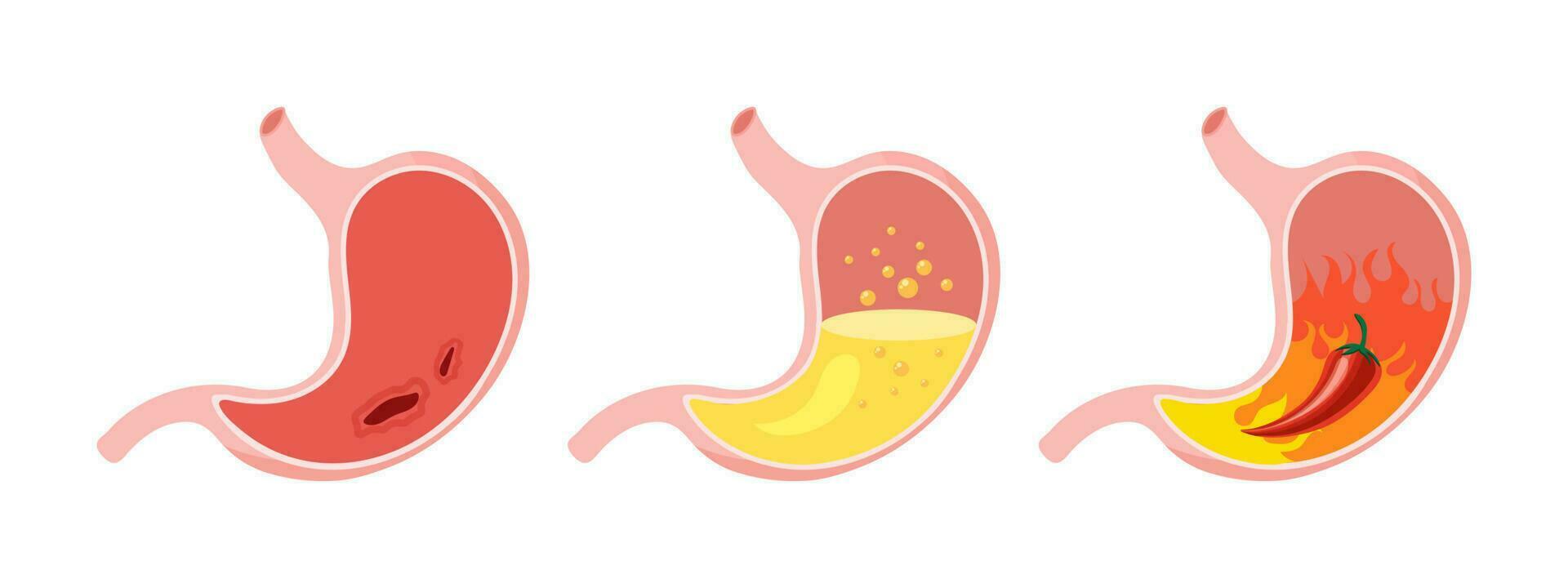 insalubre humano estómago, médico íconos colocar. gastritis, úlcera, estómago dolor, hinchazón anatomía de el digestivo sistema. vector