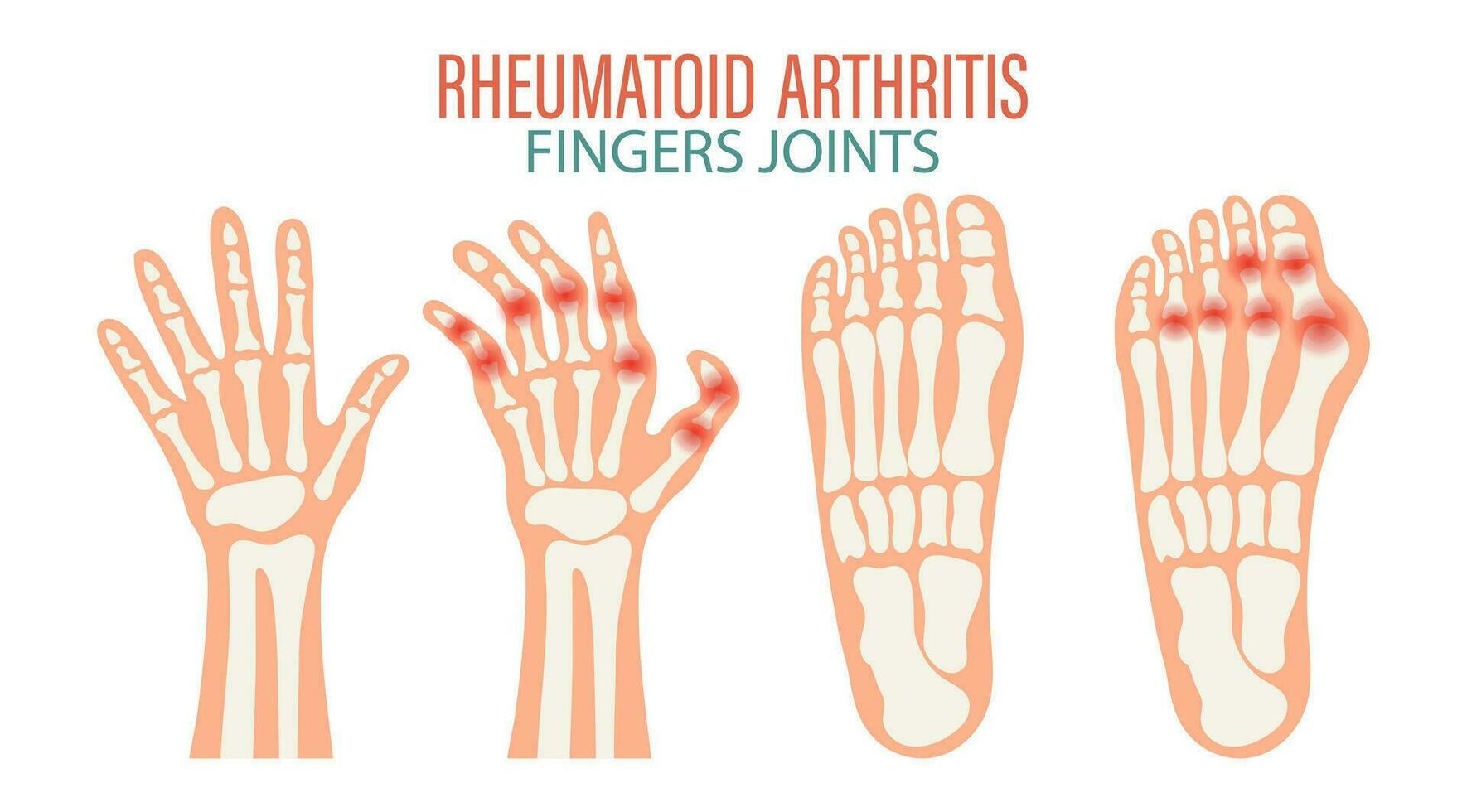 reumatoide artritis. osteoartritis de el articulaciones de el dedos y dedos de los pies. médico concepto. infografía póster, bandera, vector