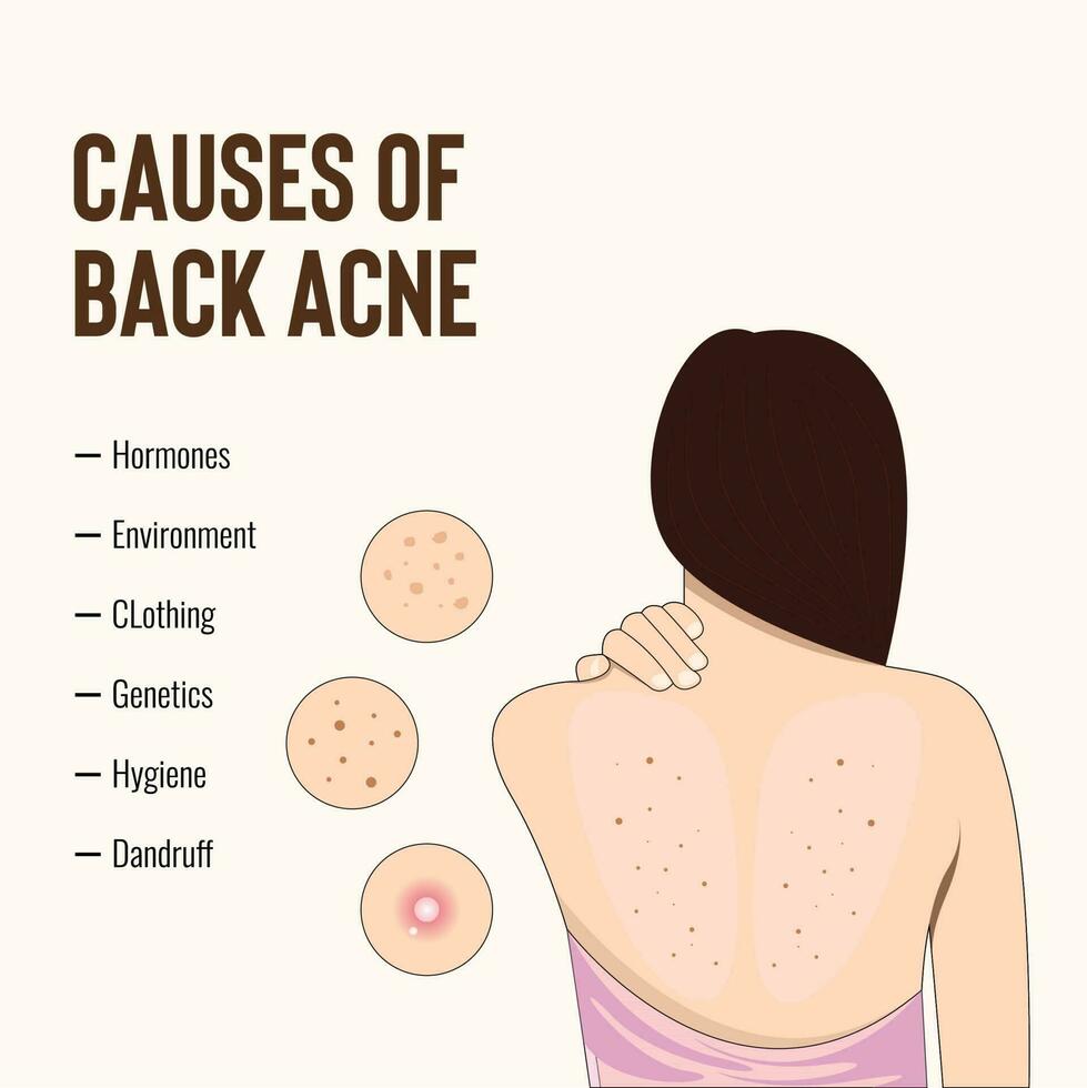 Modern Vector of Exploring the Origins of Back Acne Template Design