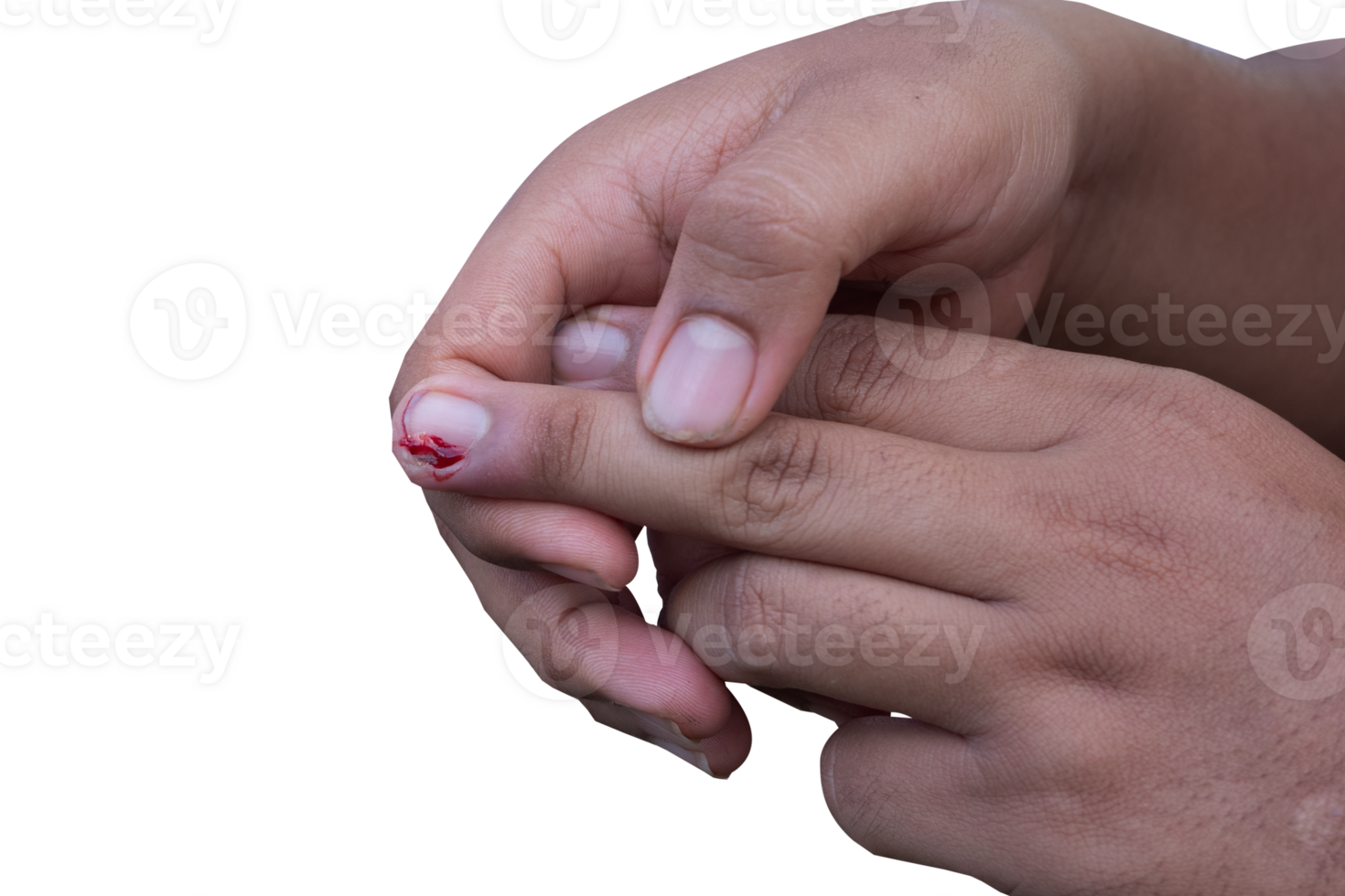 selective focus on bleeding fingers due to ingrown nails. in Indonesian it is called cantengan. paronychia disease. png