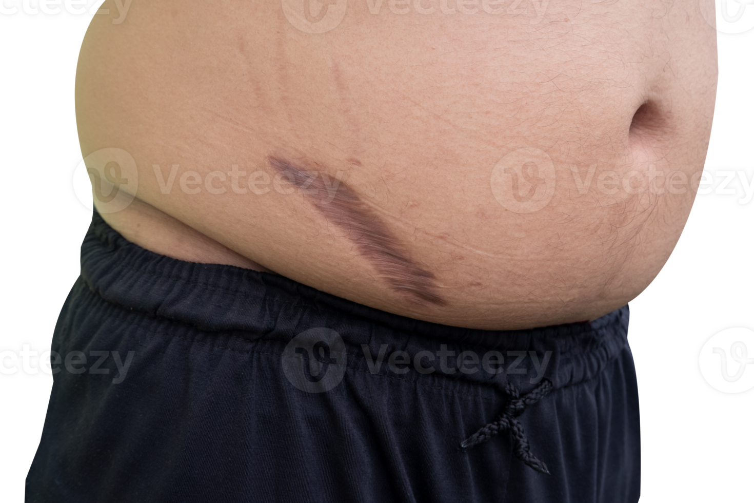 keloid scar on fat belly after appendectomy png
