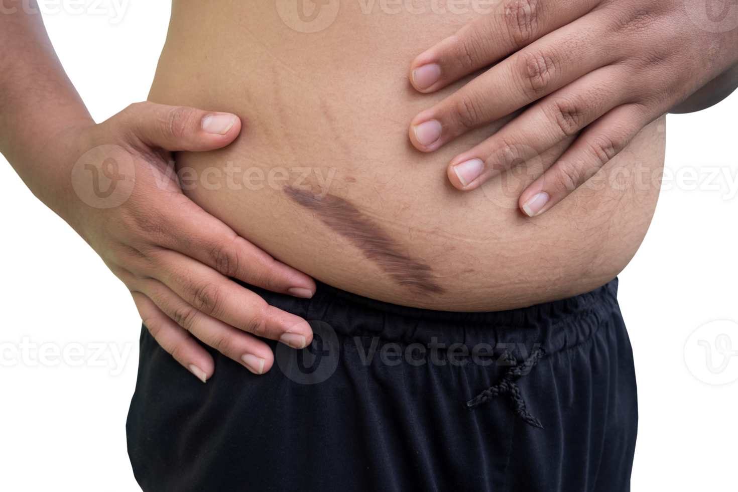 keloid scar on fat belly after appendectomy png