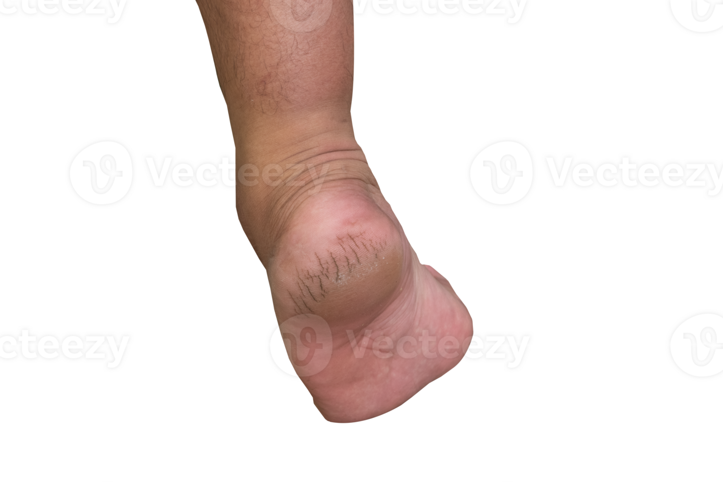 the soles of the feet cracked from dryness png