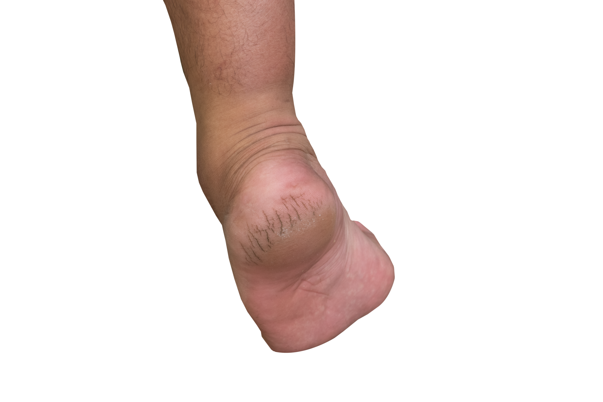 the soles of the feet cracked from dryness 24699151 PNG