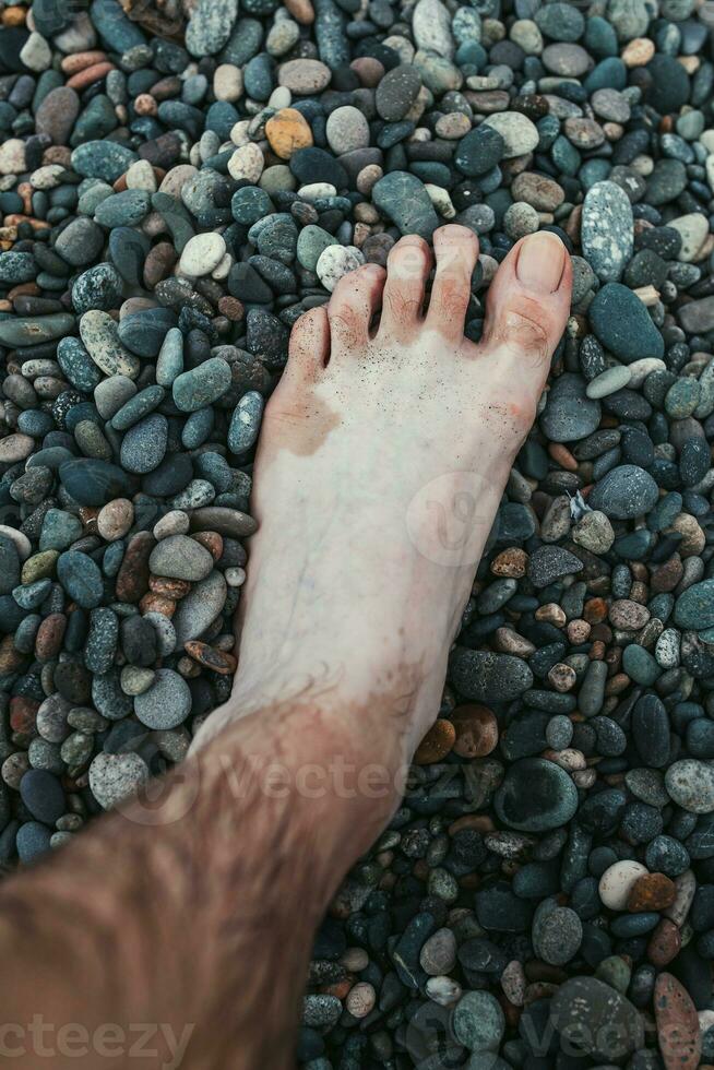 The problem of solar radiation on the skin in the form of spots - a violation of pigmentation - a man leg with white spots photo